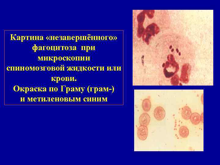 Клиническая картина гонореи