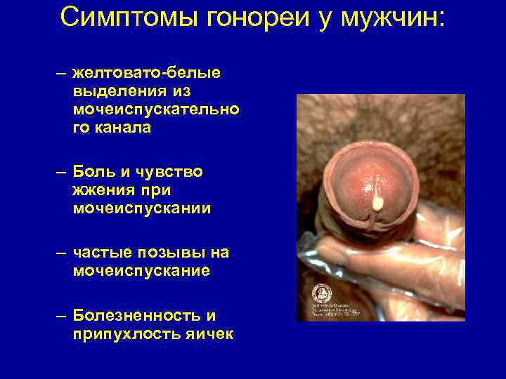 Симптомы гонореи у мужчин: – желтовато-белые выделения из мочеиспускательно го канала – Боль и