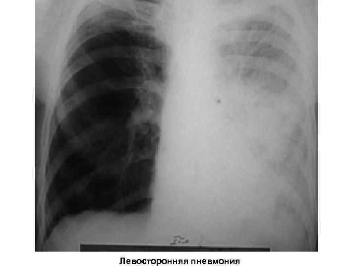 Левосторонняя пневмония 