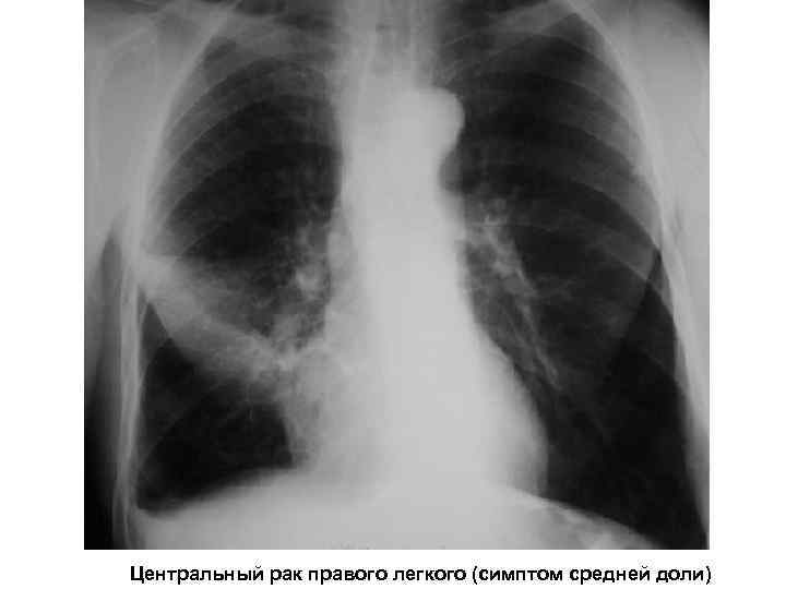 Центральный рак правого легкого (симптом средней доли) 