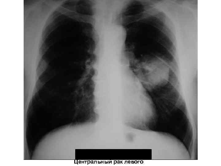 Центральный рак левого 