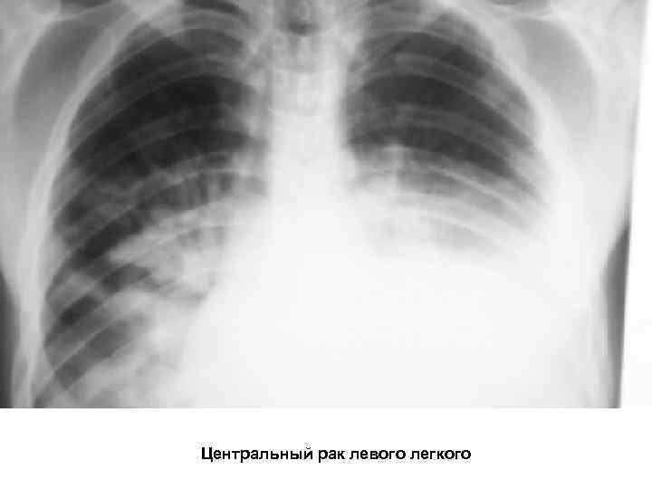 Центральный рак левого легкого 