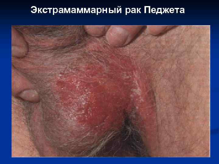 Экстрамаммарный рак Педжета 