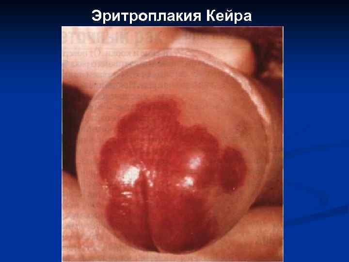 Эритроплакия Кейра 