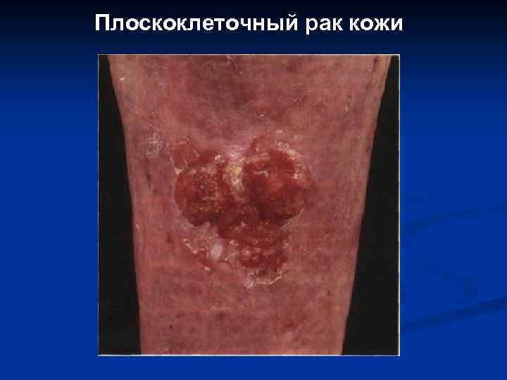 Плоскоклеточный рак кожи 