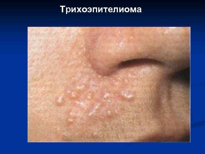 Трихоэпителиома 