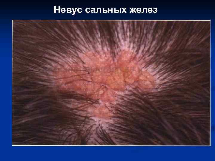 Невус сальных желез 