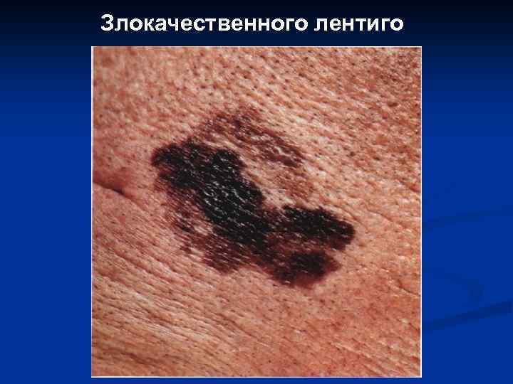 Злокачественного лентиго 
