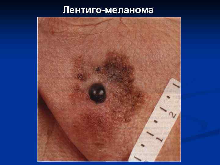 Лентиго-меланома 