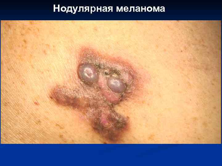 Нодулярная меланома 