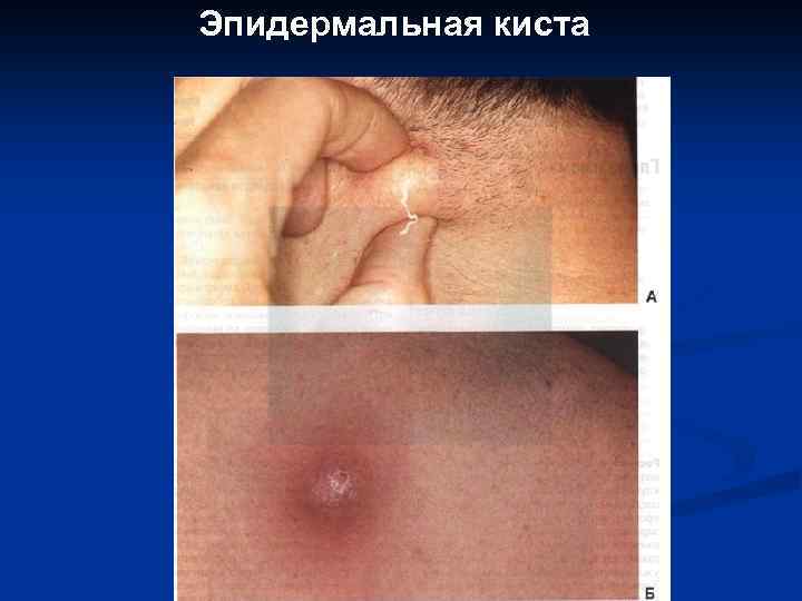 Эпидермальная киста Лазерная вапоризация 