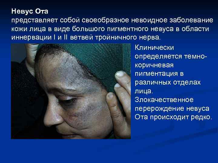 Невус Ота представляет собой своеобразное невоидное заболевание кожи лица в виде большого пигментного невуса