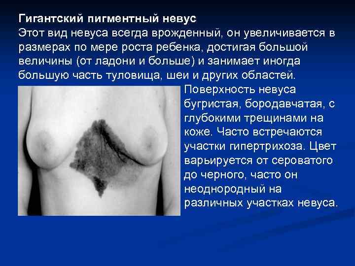 Гигантский пигментный невус Этот вид невуса всегда врожденный, он увеличивается в размерах по мере