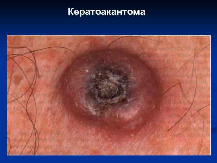 Кератоакантома 