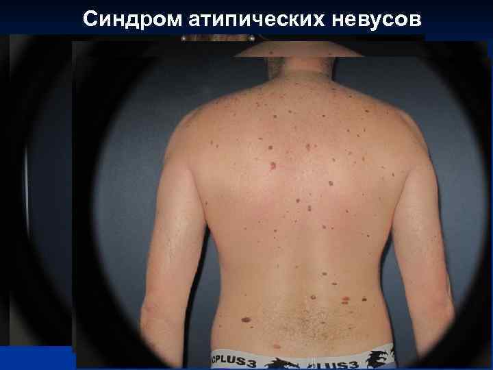 Синдром атипических невусов 