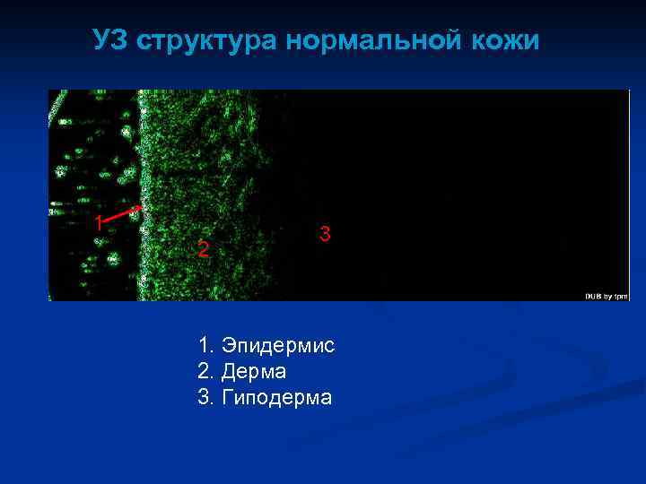 УЗ структура нормальной кожи 1 2 3 1. Эпидермис 2. Дерма 3. Гиподерма 