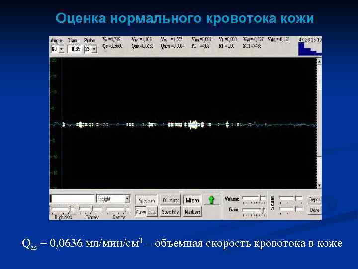 Оценка нормального кровотока кожи Qas = 0, 0636 мл/мин/см 3 – объемная скорость кровотока