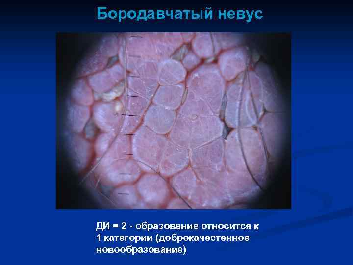 Бородавчатый невус ДИ = 2 - образование относится к 1 категории (доброкачестенное новообразование) 