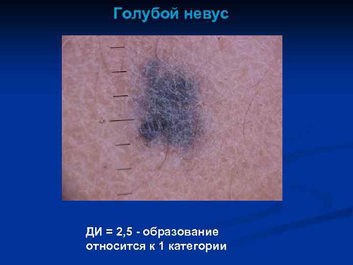 Голубой невус ДИ = 2, 5 - образование относится к 1 категории 