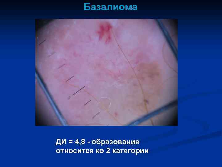 Базалиома ДИ = 4, 8 - образование относится ко 2 категории 