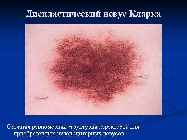 Диспластический невус Кларка Сетчатая равномерная структурна характерна для приобретенных меланоцитарных невусов 