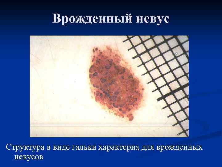 Врожденный невус Структура в виде гальки характерна для врожденных невусов 