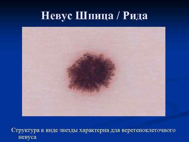 Невус Шпица / Рида Структура в виде звезды характерна для веретеноклеточного невуса 