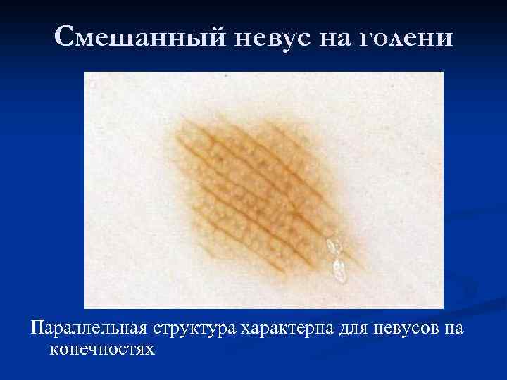 Смешанный невус на голени Параллельная структура характерна для невусов на конечностях 