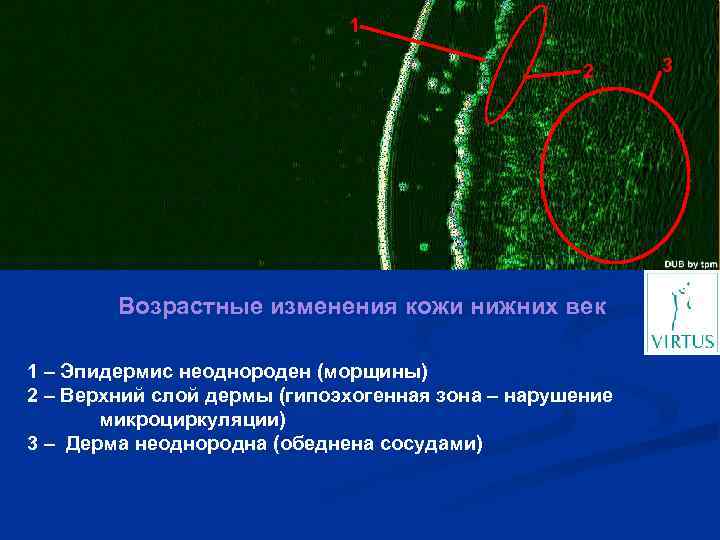 1 2 Возрастные изменения кожи нижних век 1 – Эпидермис неоднороден (морщины) 2 –