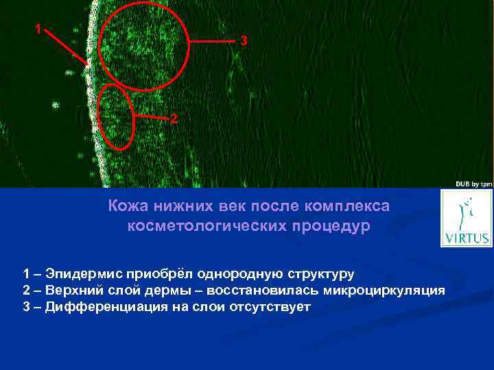 1 3 2 Кожа нижних век после комплекса косметологических процедур 1 – Эпидермис приобрёл