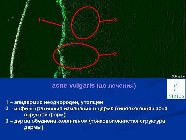 1 3 2 acne vulgaris (до лечения) 1 – эпидермис неоднороден, утолщен 2 –