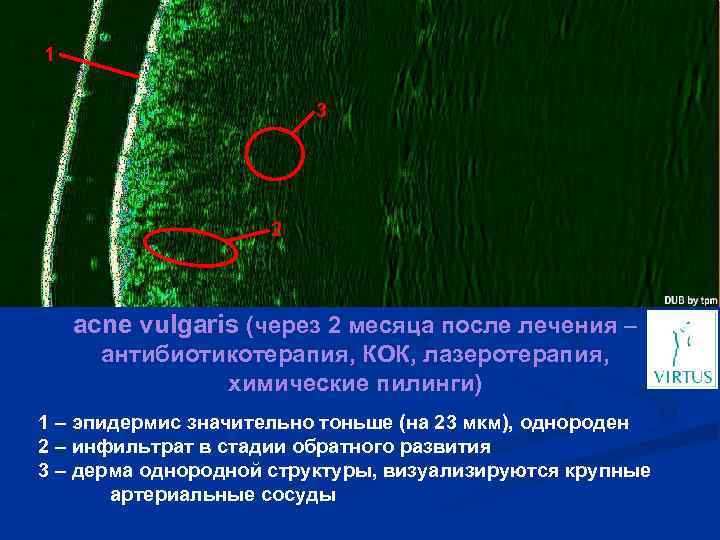 1 3 2 acne vulgaris (через 2 месяца после лечения – антибиотикотерапия, КОК, лазеротерапия,