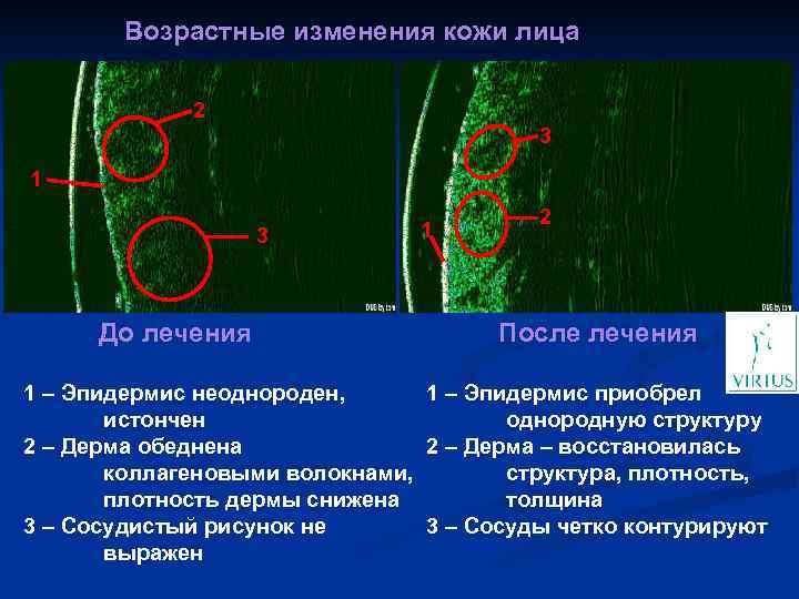 Возрастные изменения кожи лица 2 3 1 3 До лечения 1 2 После лечения