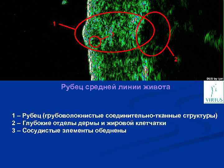 1 3 2 Рубец средней линии живота 1 – Рубец (грубоволокнистые соединительно-тканные структуры) 2