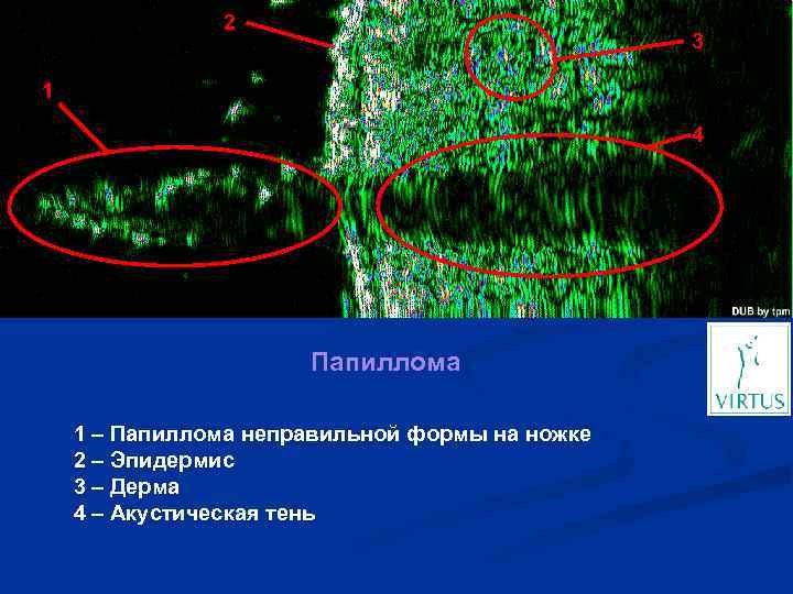 2 3 1 4 Папиллома 1 – Папиллома неправильной формы на ножке 2 –