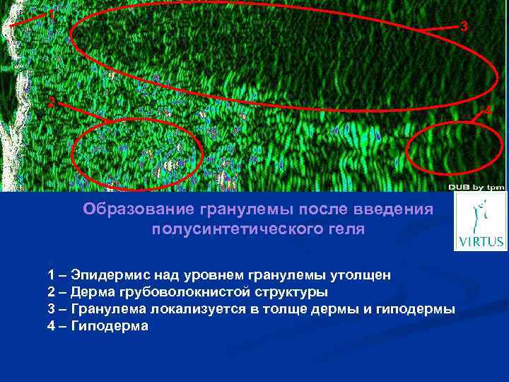 1 3 2 4 Образование гранулемы после введения полусинтетического геля 1 – Эпидермис над