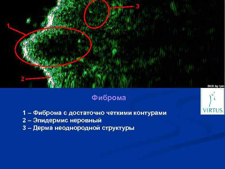 3 1 2 Фиброма 1 – Фиброма с достаточно четкими контурами 2 – Эпидермис