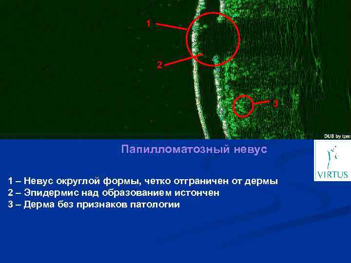 1 2 3 Папилломатозный невус 1 – Невус округлой формы, четко отграничен от дермы