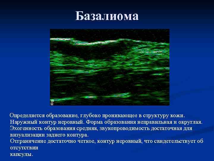 Базалиома Определяется образование, глубоко проникающее в структуру кожи. Наружный контур неровный. Форма образования неправильная
