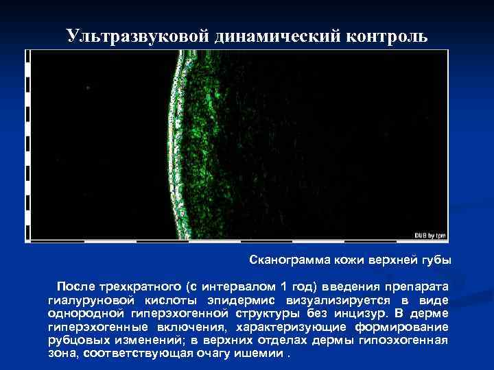 Ультразвуковой динамический контроль Сканограмма кожи верхней губы После трехкратного (с интервалом 1 год) введения