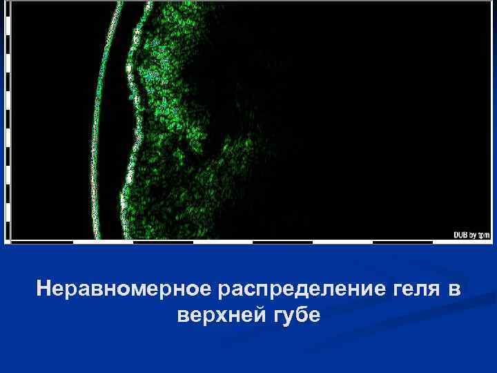 Неравномерное распределение геля в верхней губе 