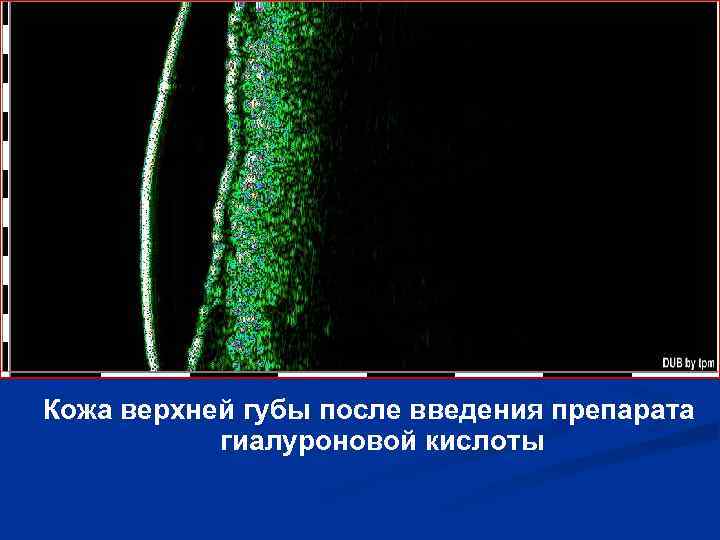 Кожа верхней губы после введения препарата гиалуроновой кислоты 