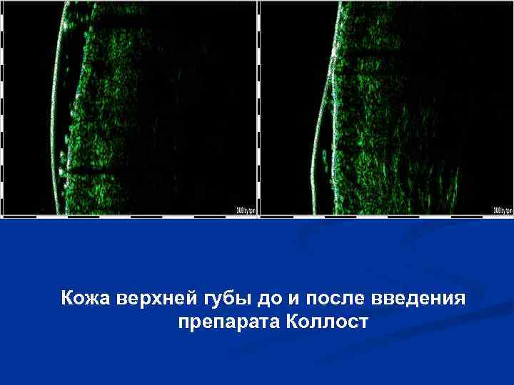 Кожа верхней губы до и после введения препарата Коллост 