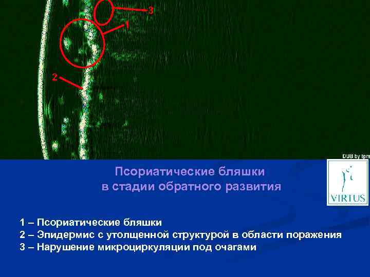 3 1 2 Псориатические бляшки в стадии обратного развития 1 – Псориатические бляшки 2