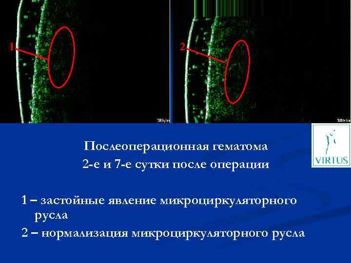 1 2 Послеоперационная гематома 2 -е и 7 -е сутки после операции 1 –