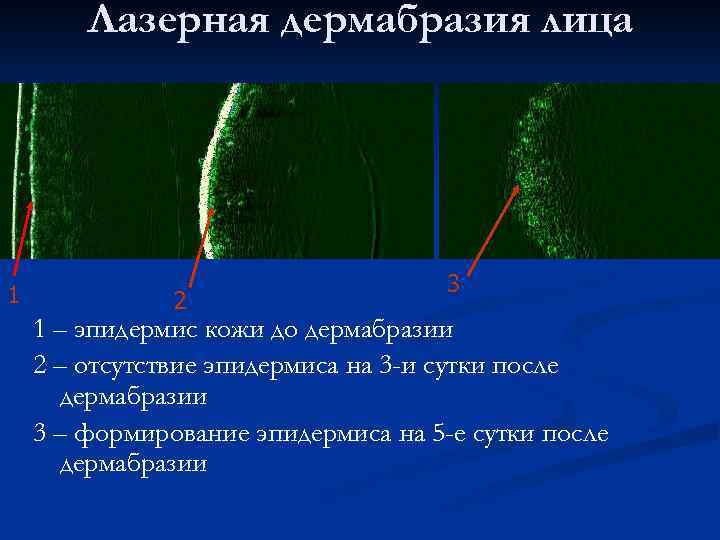 Лазерная дермабразия лица 1 2 3 1 – эпидермис кожи до дермабразии 2 –