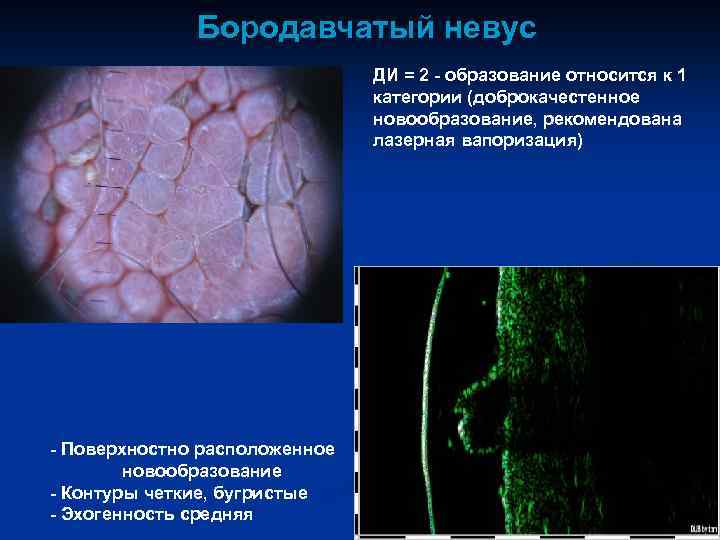Бородавчатый невус ДИ = 2 - образование относится к 1 категории (доброкачестенное новообразование, рекомендована