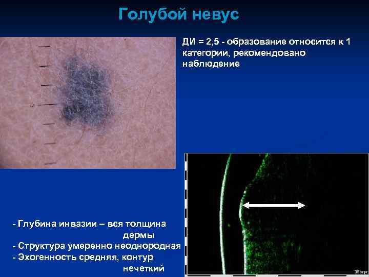 Голубой невус ДИ = 2, 5 - образование относится к 1 категории, рекомендовано наблюдение
