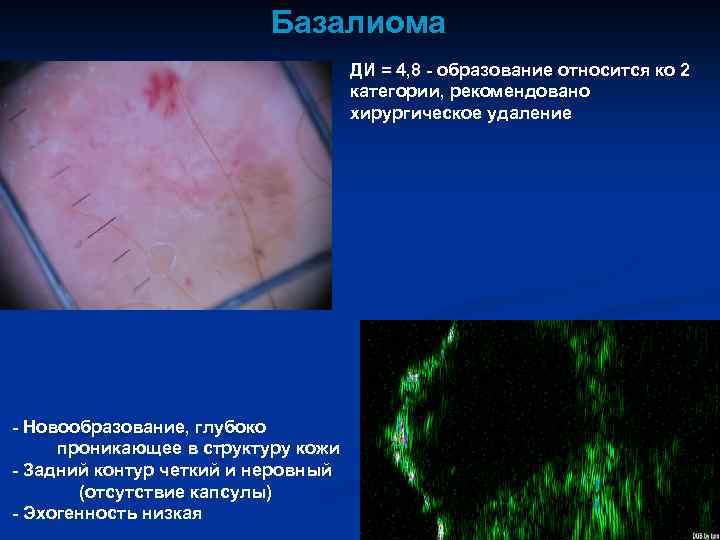 Базалиома ДИ = 4, 8 - образование относится ко 2 категории, рекомендовано хирургическое удаление