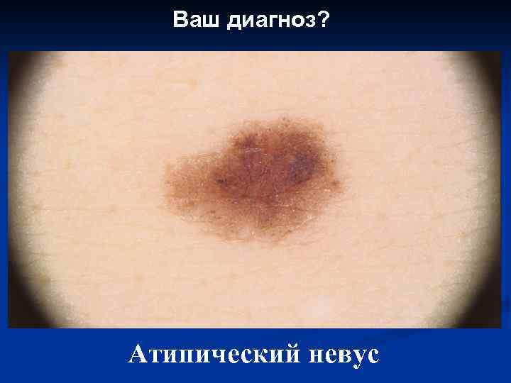 Ваш диагноз? Атипический невус 